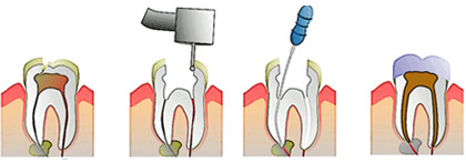 Tratamente endodontice 